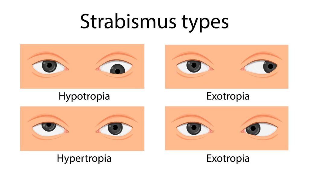 Types of Squint (Strabismus) in Children
