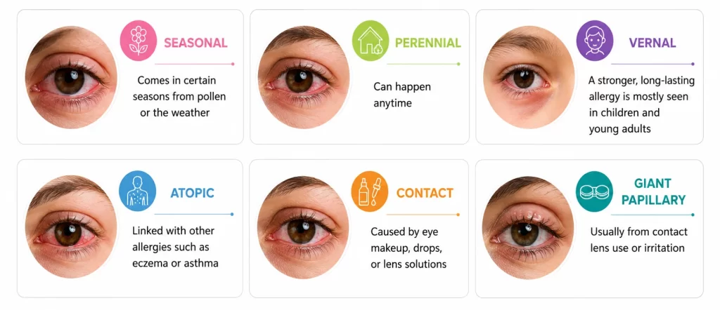 Types of Allergy Conjunctivitis in Eye